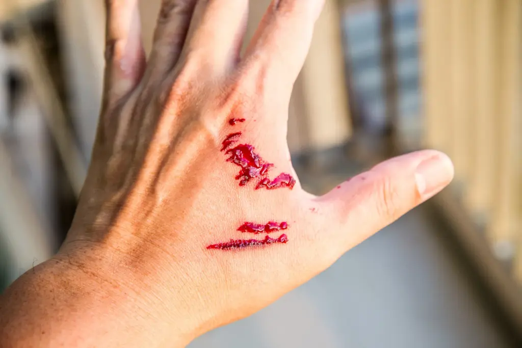 A man with a dog bite on his hand.